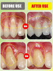 Gum recession, bleeding teeth, and tooth pain will all disappear. The most powerful technology in 2025