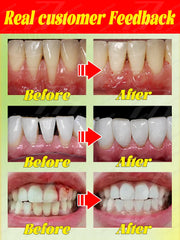 Gum recession, bleeding teeth, and tooth pain will all disappear. The most powerful technology in 2025